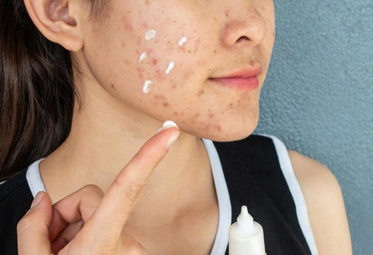 Những lý do khiến da mãi không hết mụn, bạn có đang mắc phải những lỗi này? 1