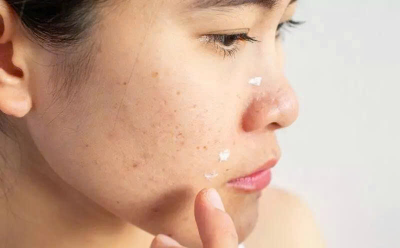 Những lý do khiến da mãi không hết mụn, bạn có đang mắc phải những lỗi này? 2